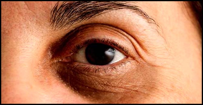 how you can avoid dark circles, and reduce them